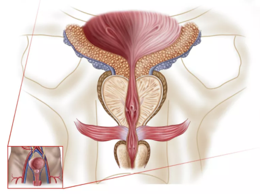  前列腺增大伴鈣化的治療方法